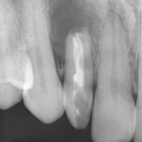 歯根端切除術 術前