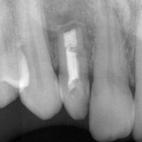 歯根端切除術 術後1年